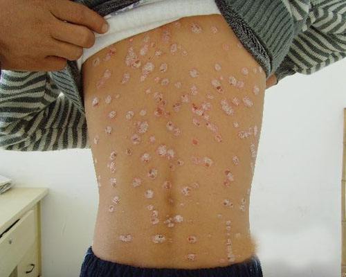 白癜风图片 白癜风图片