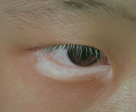 男性患了白癜风会出现哪些症状呢？.jpg