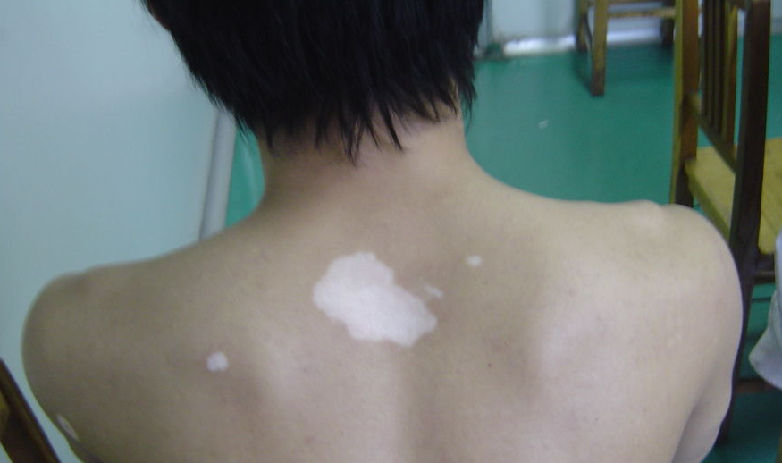 白癜风治疗的必要性.jpg