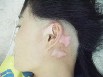 在脖子后面的皮肤上有一块白斑是白癜风吗？.jpg