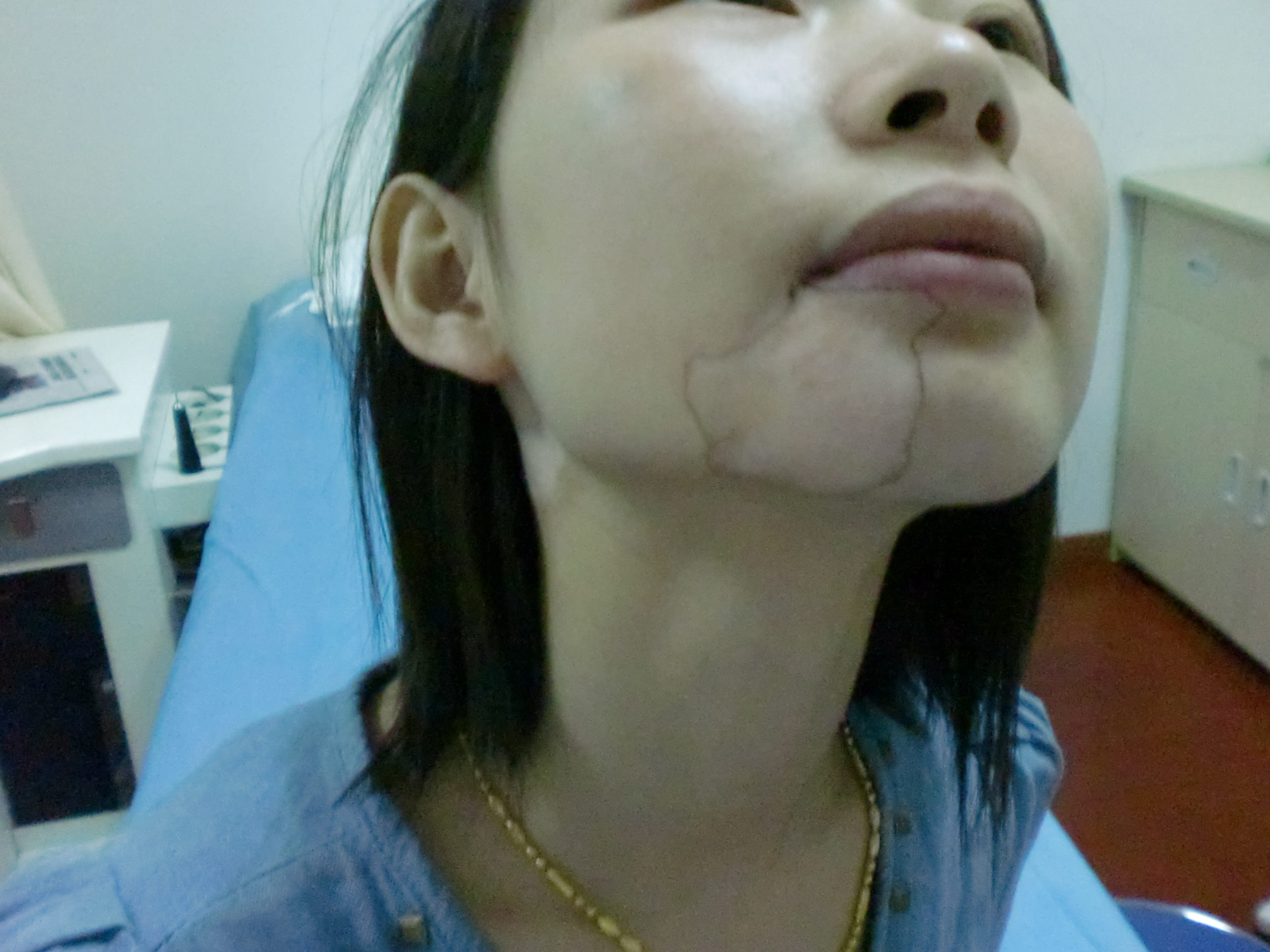 面部白癜风的危害.JPG