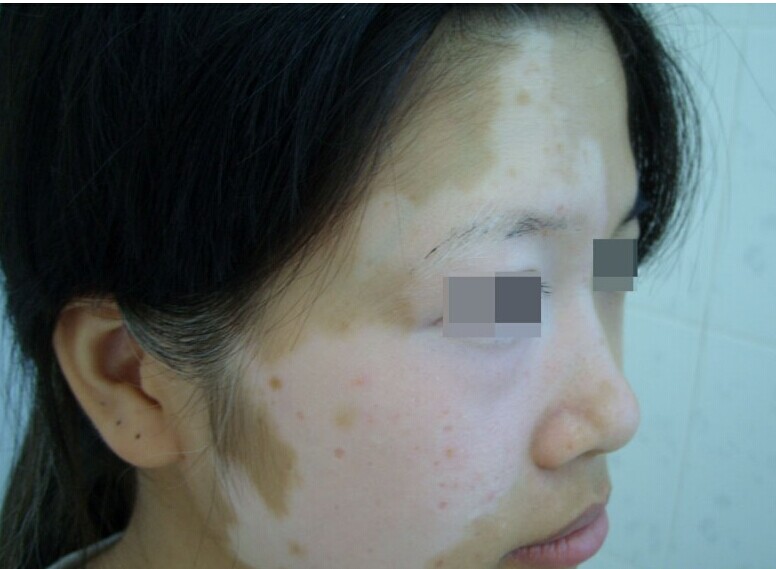 女性白癜风的原因有哪些.jpg