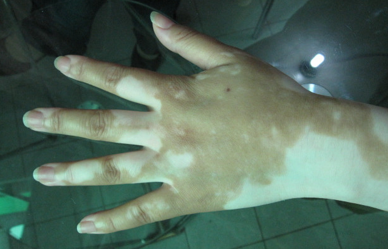肢端型白癜风要注意什么.jpg