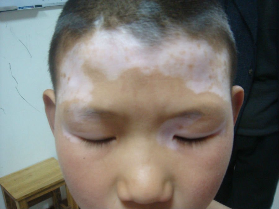青少年白癜风前期表现.jpg